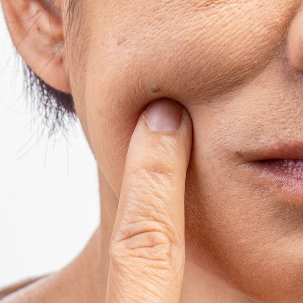 Loss of skin firmness & elasticity