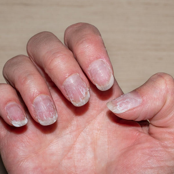 Brittle or flaky nails